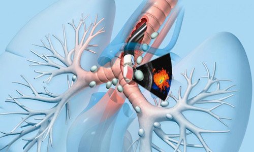 Pediatric Thoracoscopic surgery in Nagpur