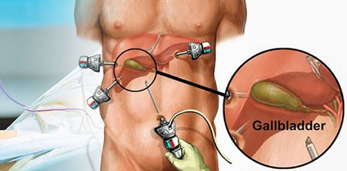 laparoscopy gall bladder surgery in nagpur