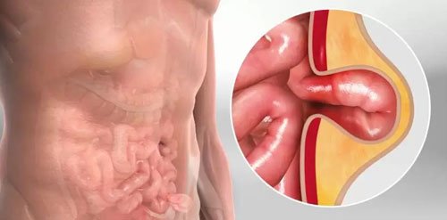 Pediatric Hernia Treatment in Nagpur